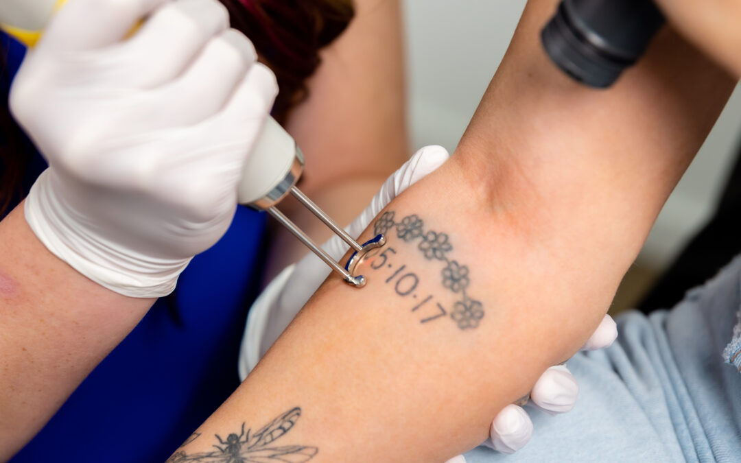 Does Tattoo Removal Hurt?