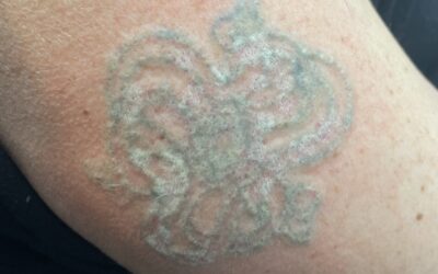 Exploring the Impact of Tattoo Location on Laser Tattoo Removal