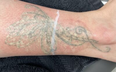 The Science Behind Laser Tattoo Removal