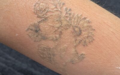 Laser Tattoo Removal Treatment Aftercare: A Comprehensive Guide