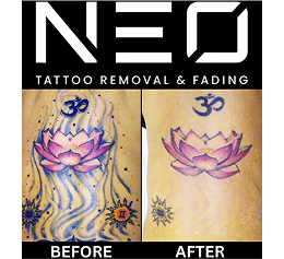 Contact Neo Tattoo – Book Your Removal Today