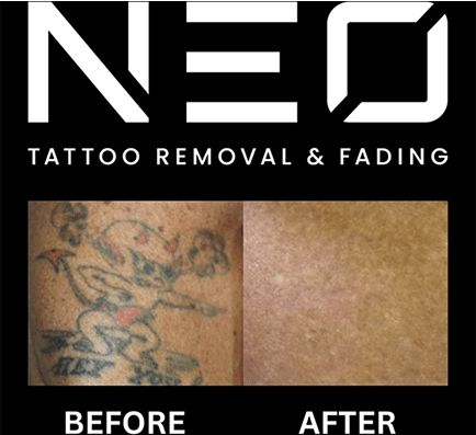 Neo Tattoo Removal Safe, Fast & Affordable