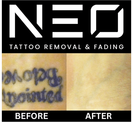 Neo Tattoo Removal Safe, Fast & Affordable