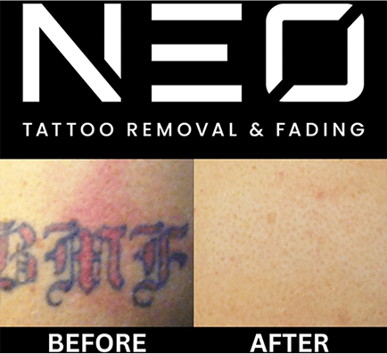 Neo Tattoo Removal Safe, Fast & Affordable
