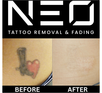 Neo Tattoo Removal Safe, Fast & Affordable