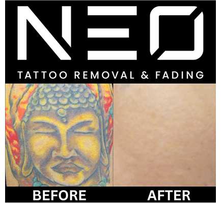 Neo Tattoo Removal Safe, Fast & Affordable