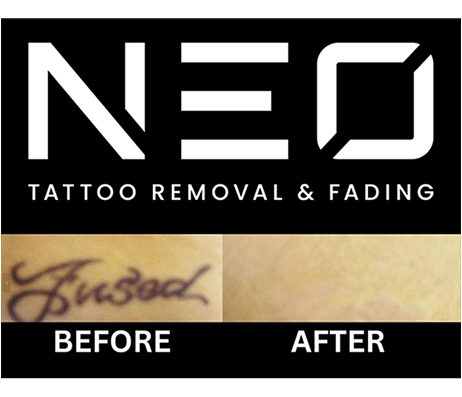 Neo Tattoo Removal Safe, Fast & Affordable