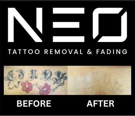 Tattoo Removal Process
