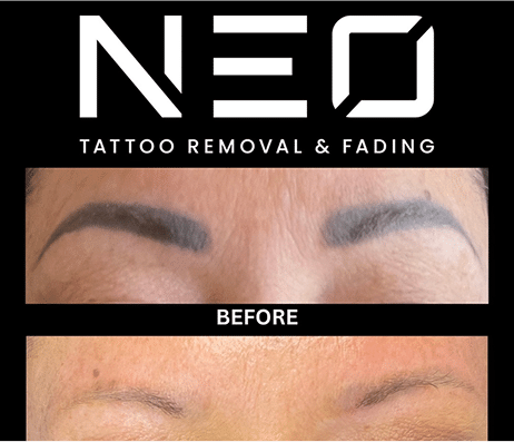 Neo Tattoo Removal Before