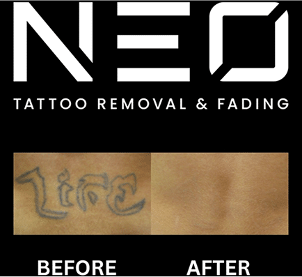 Neo Tattoo Removal Safe, Fast & Affordable