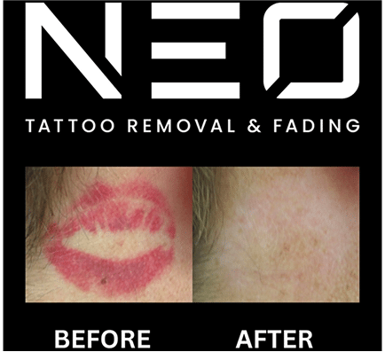 Neo Tattoo Removal Safe, Fast & Affordable