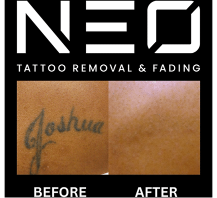 Neo Tattoo Removal Safe, Fast & Affordable