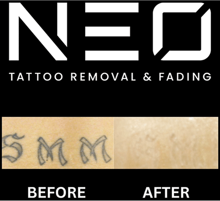 Tattoo Removal Safe, Fast & Affordable